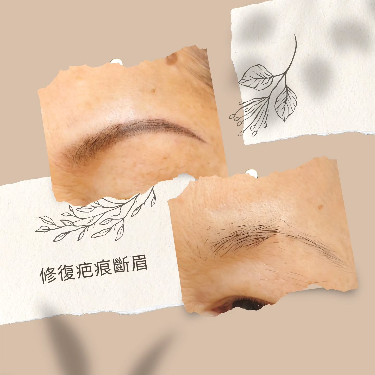 修復疤痕斷眉
